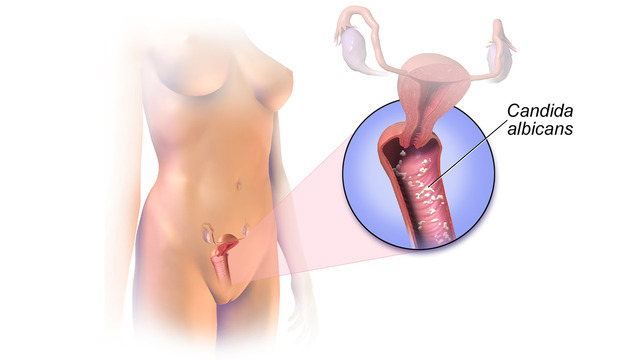 Как распознать и отличить инфекционный вульвовагинит от вагиноза?